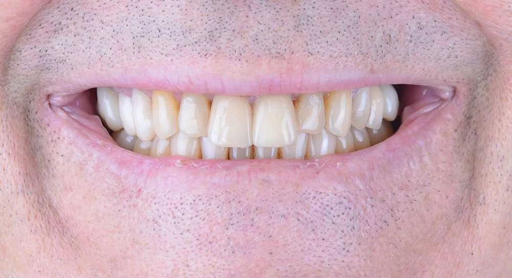 Maciej emax laminate smile makeover treatment in Turkey