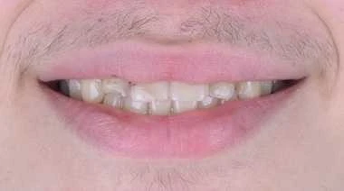 Glenn Invisalign Before Smile