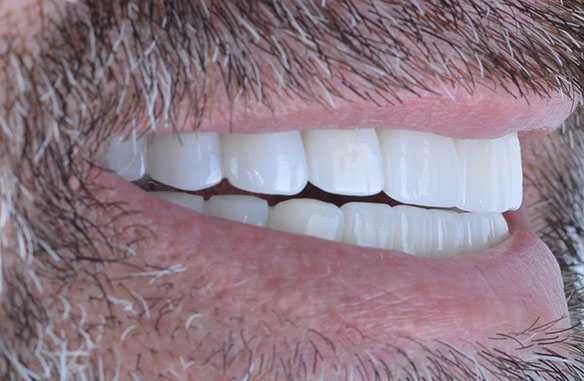 Jonah Dental Implants in Turkey
