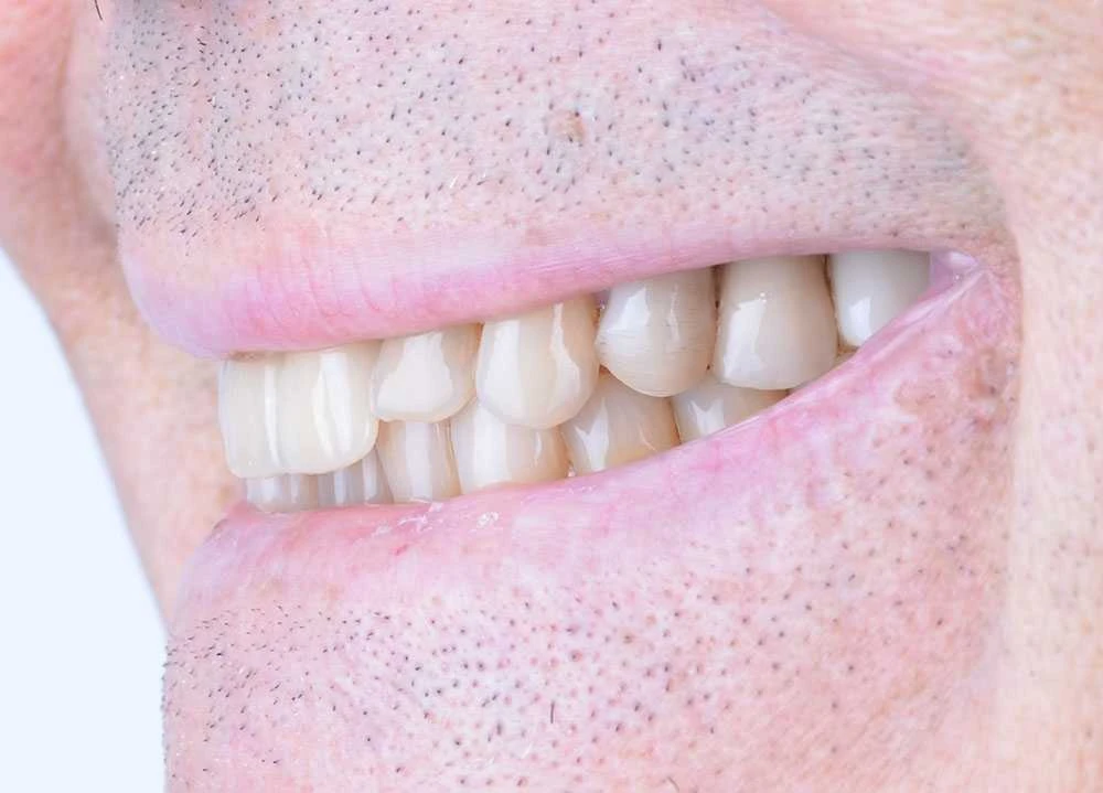 Maciej emax laminate smile makeover treatment in Turkey