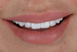 Elena Smilemakeover Turkey Teeth