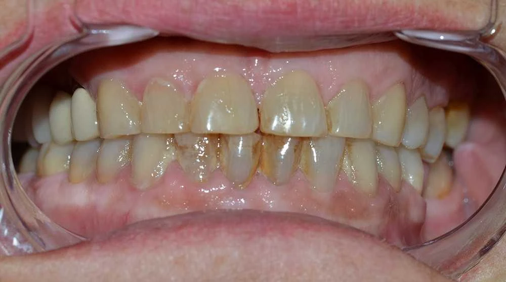 Georgiana Zirconium Crowns Treatment Before