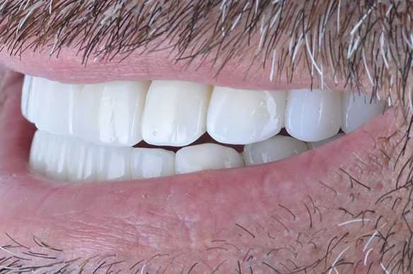 Jonah Teeth Implants Turkey