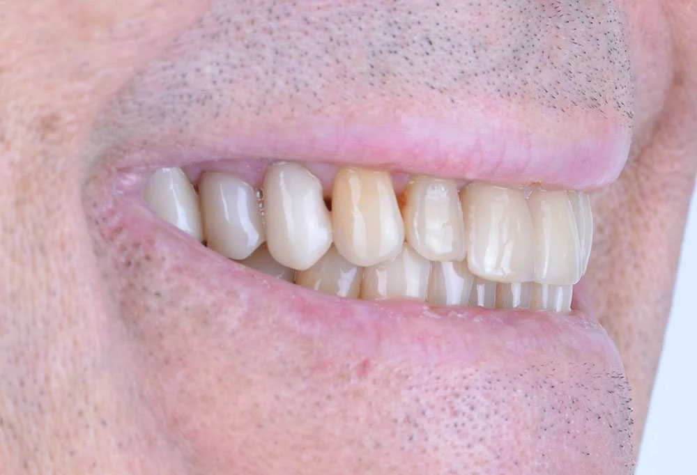 Maciej emax laminate smile makeover treatment in Turkey