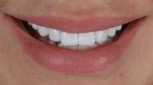 Elena Smilemakeover Turkey Teeth