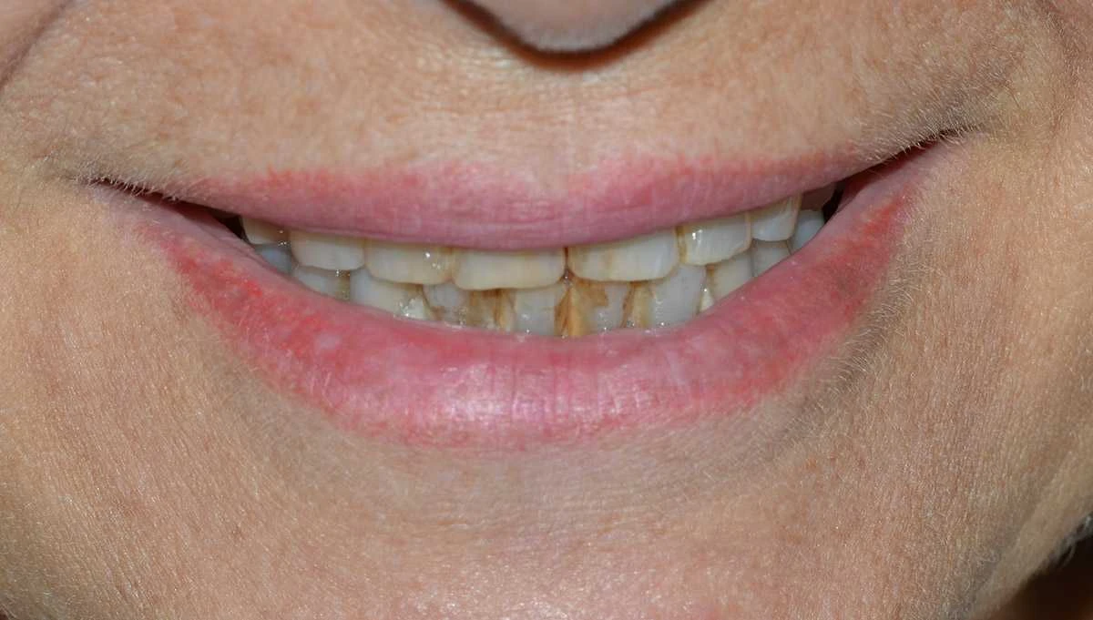 Georgiana Zirconium Crowns Treatment Before