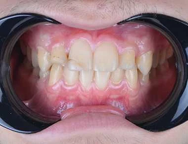 Glenn Invisalign Before Turkey sp fr