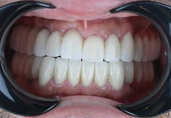 Jonah Turkey Veneers