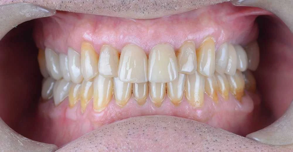 Maciej emax laminate smile makeover treatment in Turkey