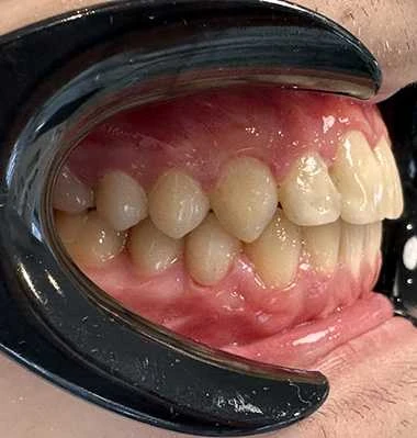 Glenn Invisalign After Smile Rear sp