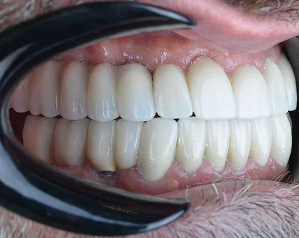 Jonah Veneers Turkey