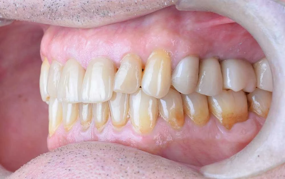 Maciej emax laminate smile makeover treatment in Turkey