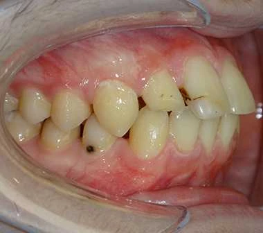 Glenn Invisalign Before Rear Smile s