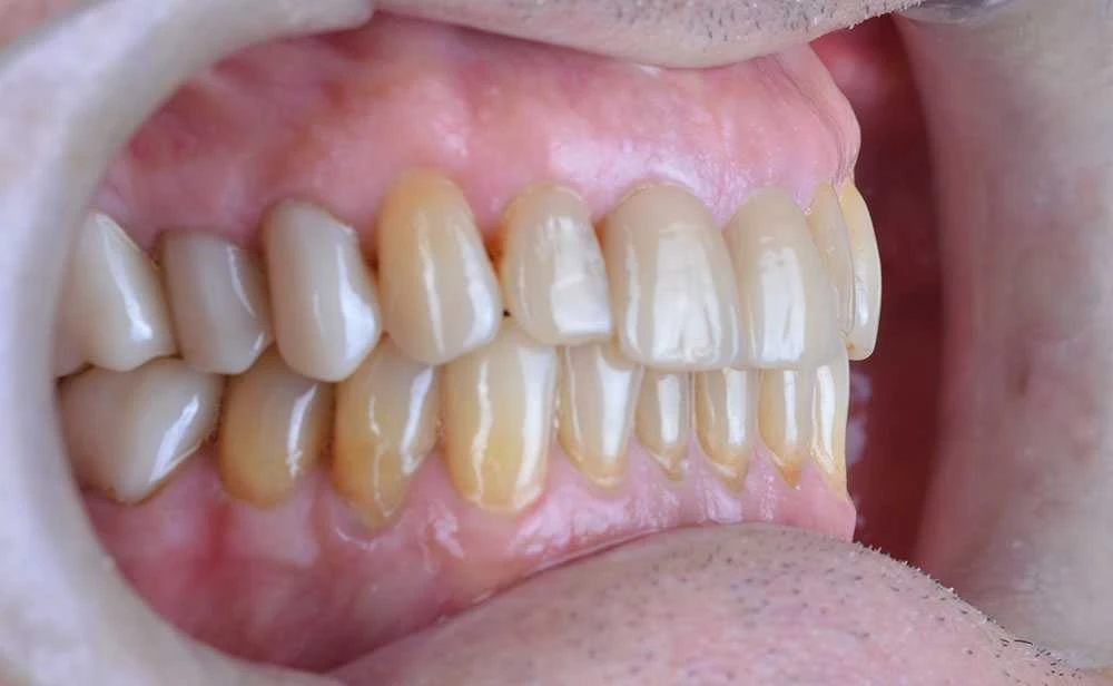 Maciej emax laminate smile makeover treatment in Turkey