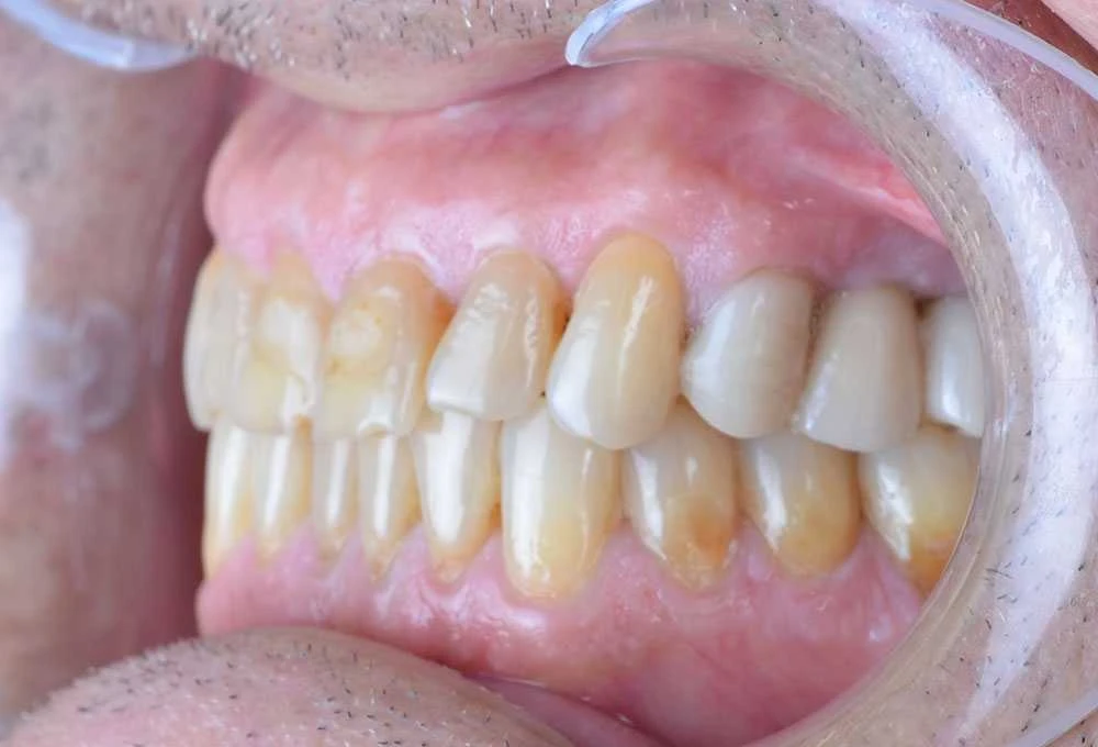 Maciej emax laminate smile makeover treatment in Turkey