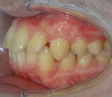 Glenn Invisalign Before Smile Rear2