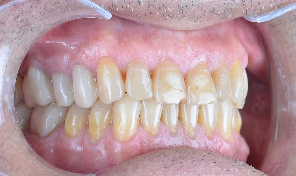 Maciej emax laminate smile makeover treatment in Turkey