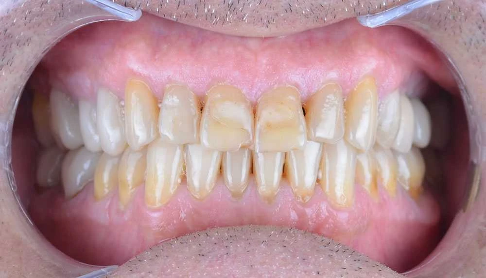 Maciej emax laminate smile makeover treatment in Turkey
