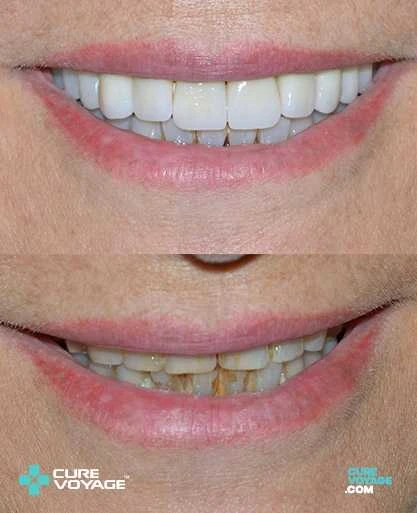 Zirconium Crowns Smile Makeover Before After