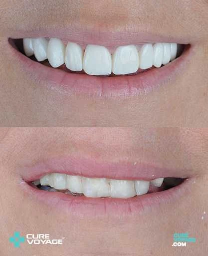 Zirconium Crowns Smile Makeover Before After