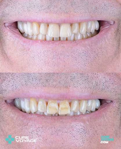 Emax Laminate Veneer Smile Makeover