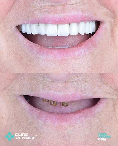 Dental Implants Zirconium Crowns Before After