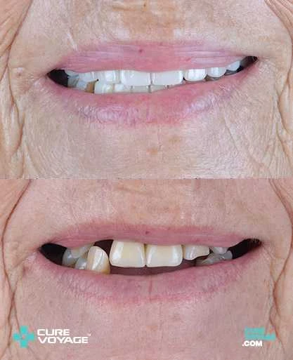 All on Four Treatment Before After