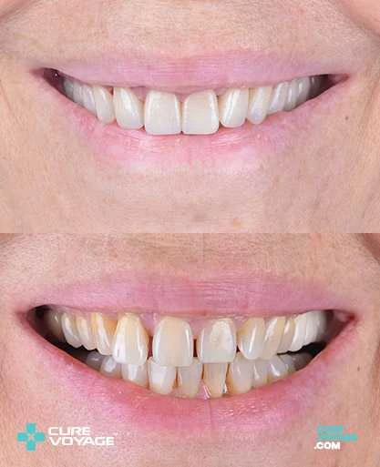 Zirconium Crowns Smile Makeover Before After
